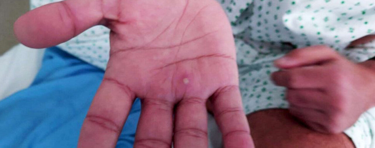 What You Should know About Monkeypox Safety & Patient Care