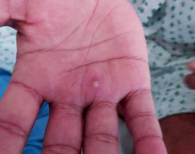 What You Should know About Monkeypox Safety & Patient Care